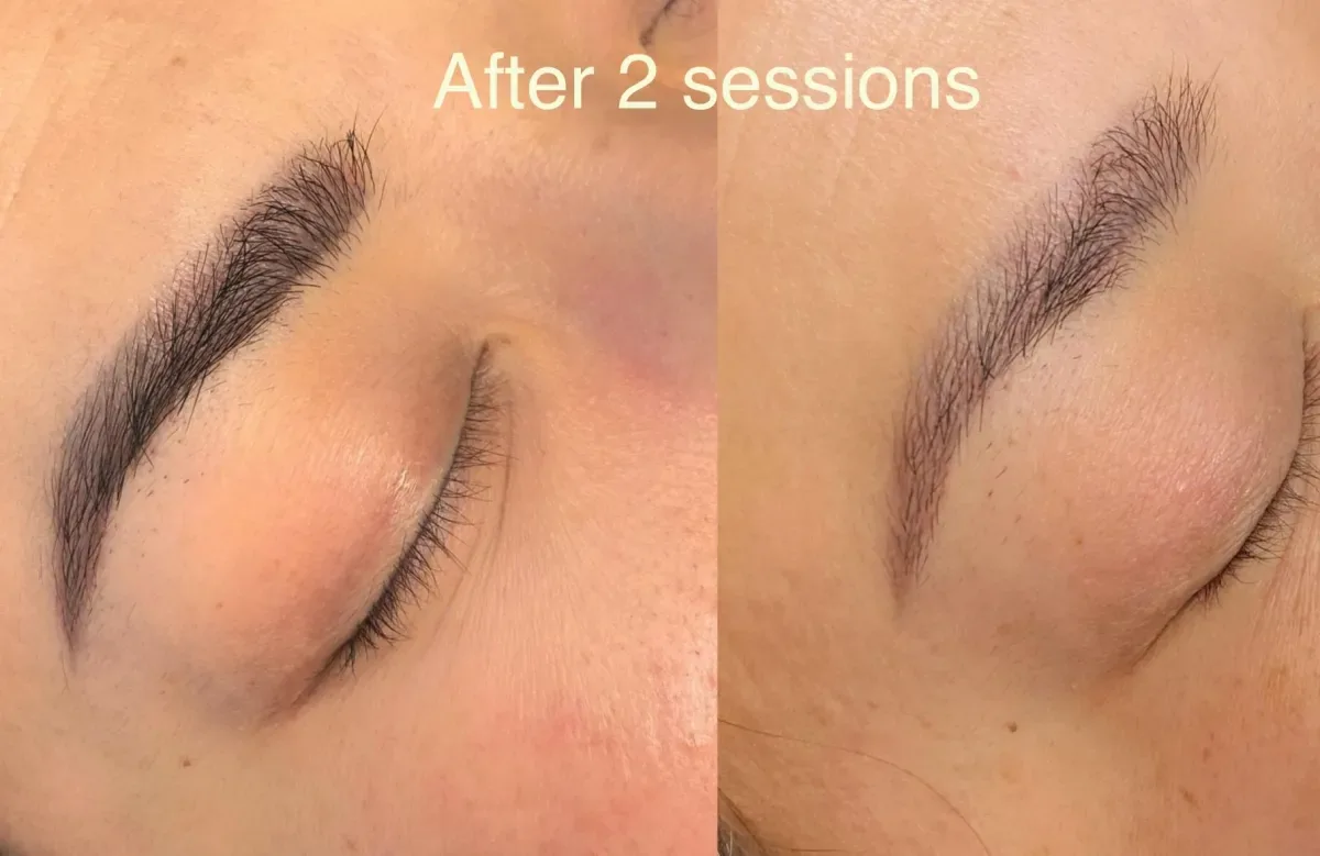 Non-laser PMU removal in Prescott, AZ — glycolic acid technique by Brow Expressions